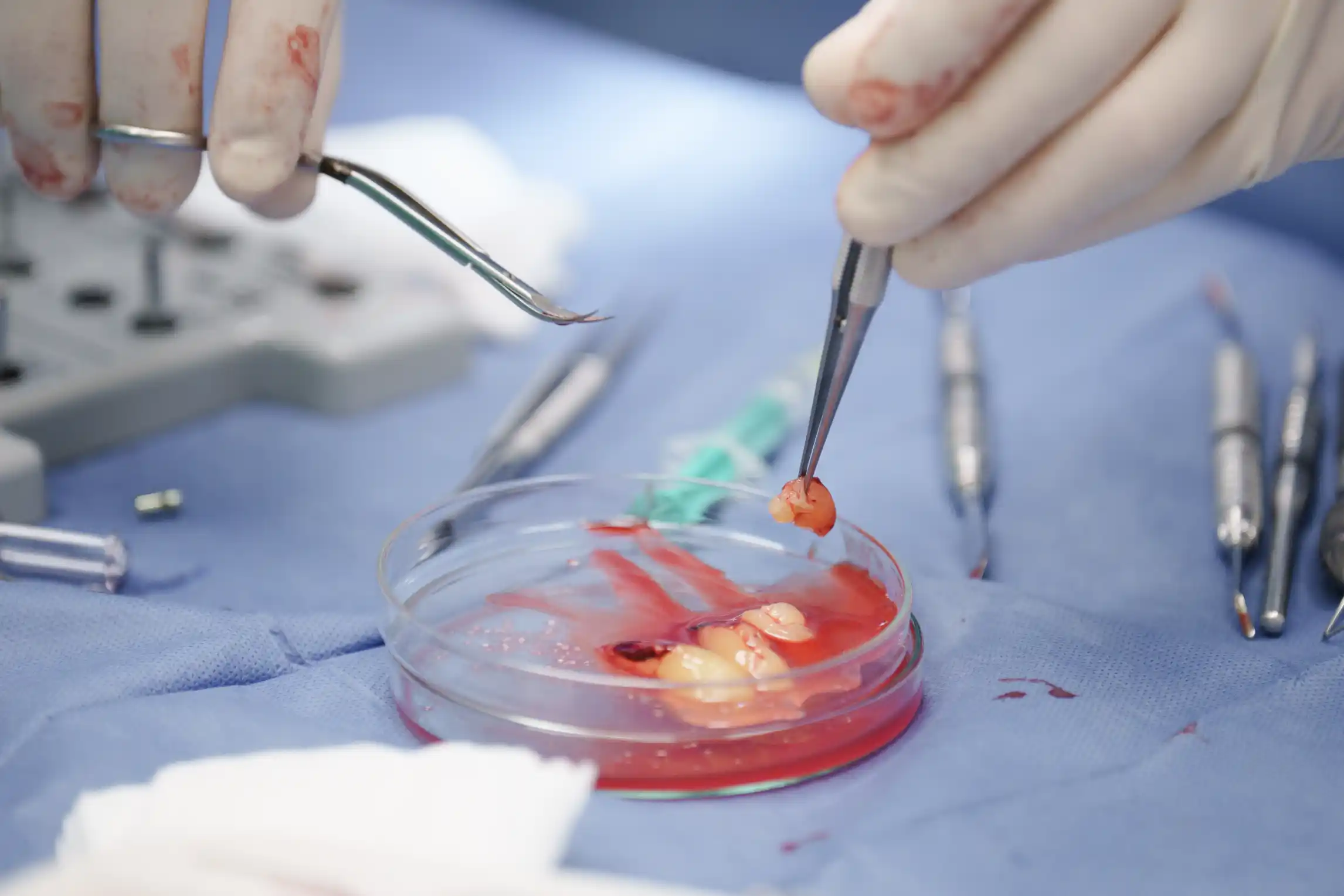 Leczenie recesji dziąsłowych w obrębie zębów własnych pacjentów i implantów